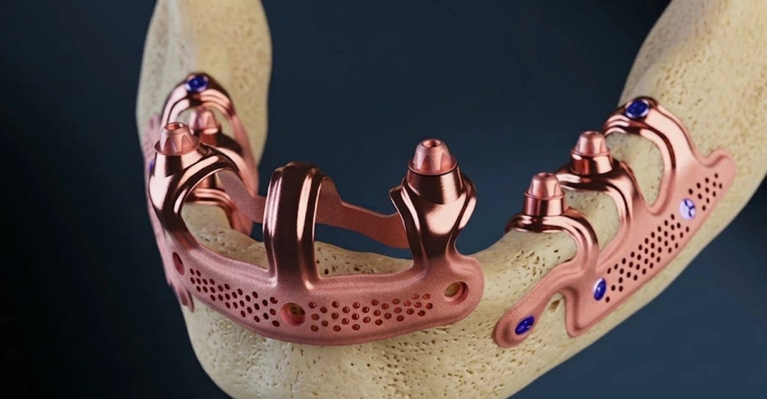 is subperiosteal implant painful2 (1)
